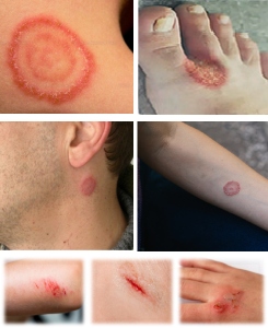 Antifungal and antibacterial creams - HFL Healthcare & Wellness